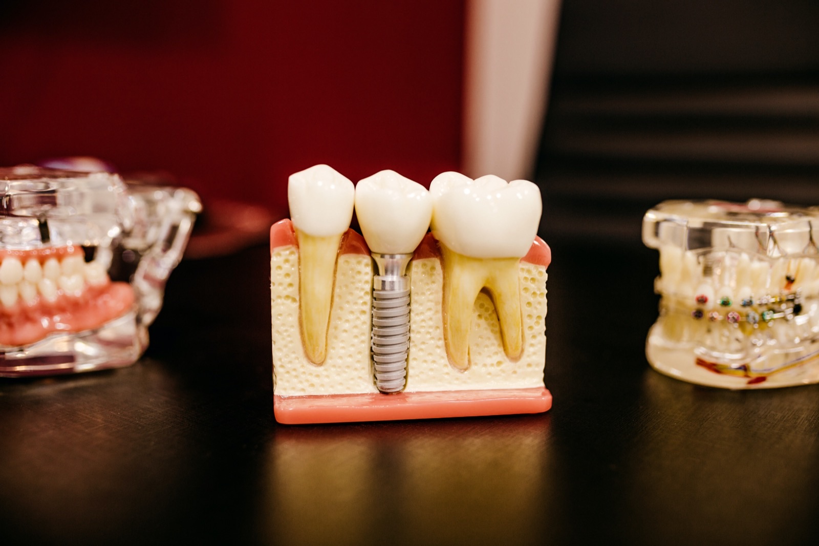 İmplant ve köprü modelleri – implant ömrü