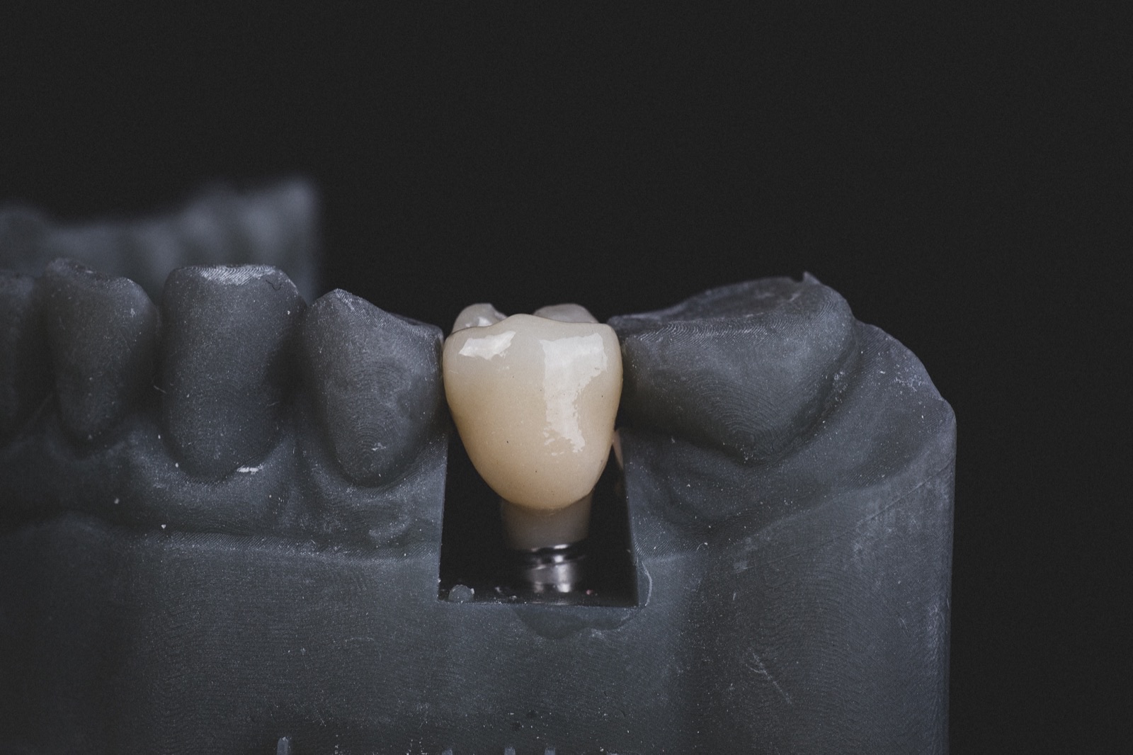 Bursa'da diş implantı uygulaması sonrası yerleştirilmiş titanyum implant ve porselen diş görünümü