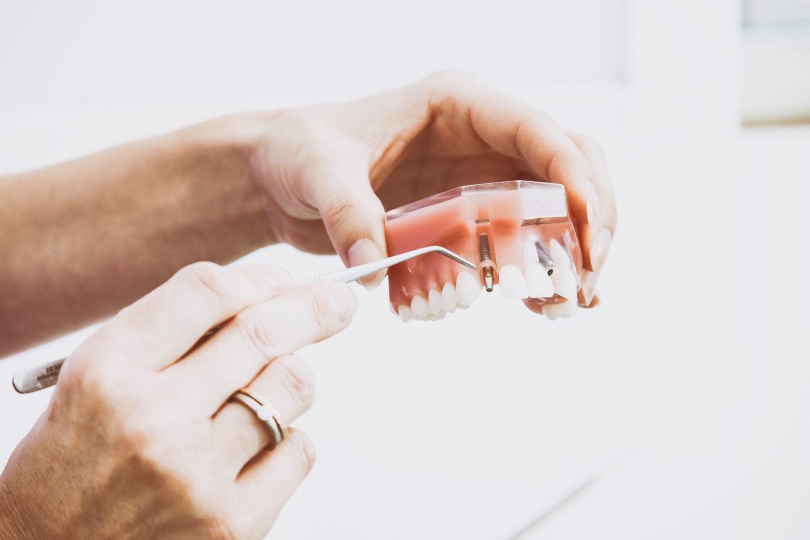 Bursa implant tedavisi sürecini gösteren diş implant modeli, Bursa diş kliniğinde implant uygulaması