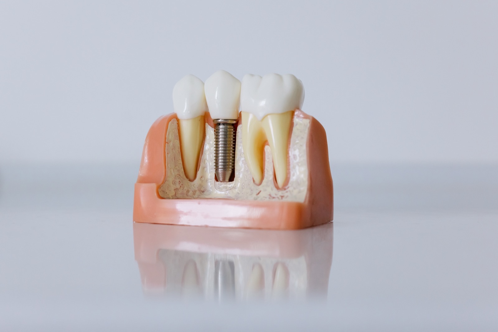Diş implantı modeli